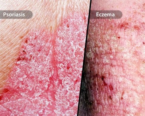 Allergy, Eczema & Psoriasis in Roorkee